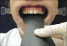 Контрастера L, для передних зубов (YDM)