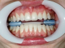 Мультифункциональный ретрактор для губ FGM Arcflex