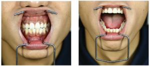 Роторасширитель Osung LIPWD-6540 (металлический, малый размер)