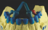 CASTING BARS WITH RESERVOIRES (Distrident Plus) Литниковые бруски с резервуарами, 50 шт