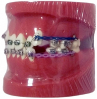 Демонстрационная модель, ортодонтическая XINGXING, с микроимплантами (красная) М3005