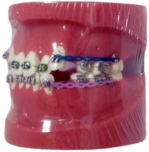 Демонстраційна модель, ортодонтична XINGXING, з мікроімплантами (червона) М3005