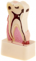 Демонстрационная модель зуба XINGXING, с патологиями М4015 (в разрезе)
