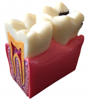 Демонстрационная модель кариеса зубов Paro Swiss