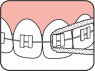 Флос для мостів та імплантів TePe (304-0106)