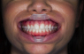 Umbrella (Ultradent) Роторозширювач з язикотримувачем, 1 шт