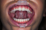 Umbrella (Ultradent) Роторозширювач з язикотримувачем, 1 шт