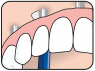 Специальная зубная щетка TePe Universal Care (блистер) 304-0077