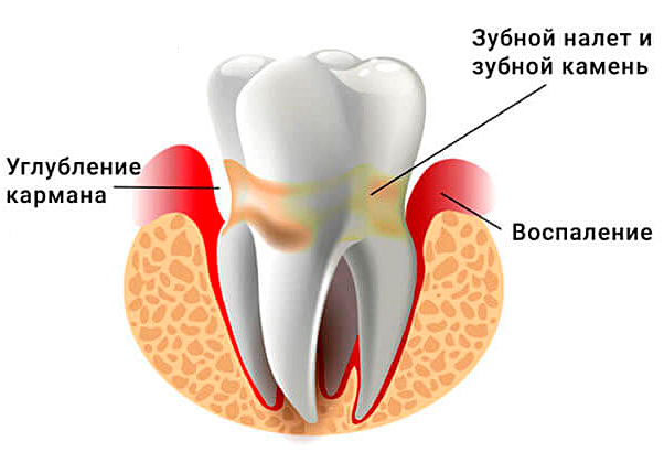 что такое периодонтит зуба
