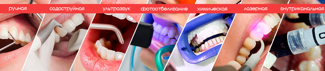 разновидности чистки и отбеливания зубов